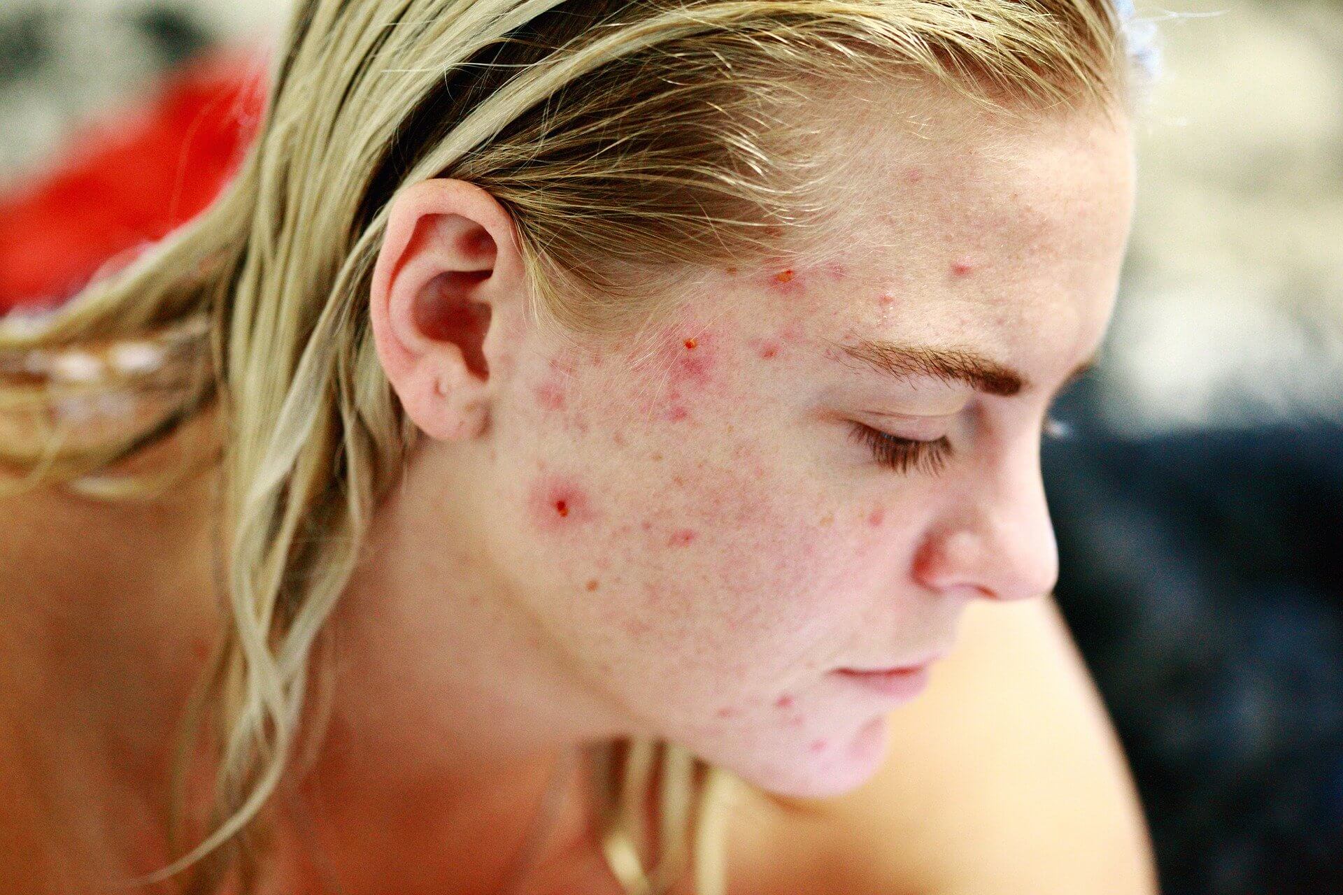 Acne and Eczema