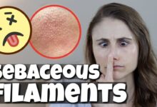 Get Rid of Sebaceous Filaments Overnight