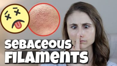 Get Rid of Sebaceous Filaments Overnight