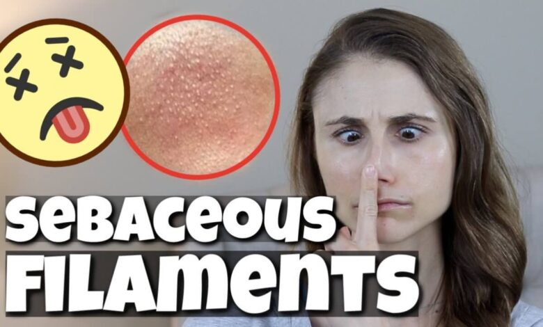 Get Rid of Sebaceous Filaments Overnight