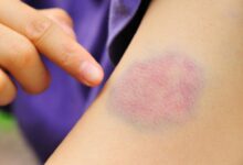 How to Get Rid of a Bruise