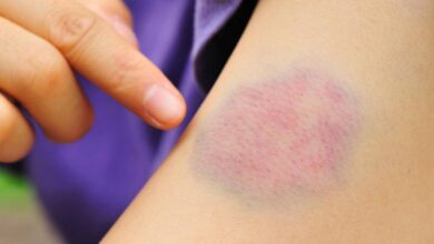 How to Get Rid of a Bruise