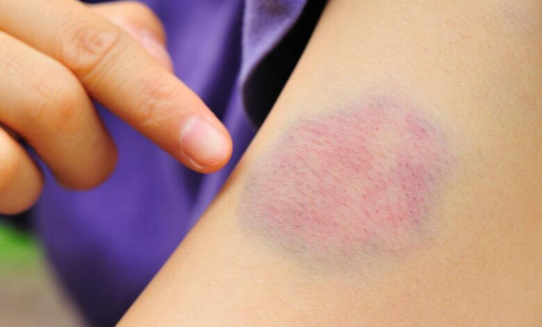 How to Get Rid of a Bruise