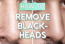 Ways To Remove Blackheads