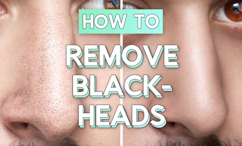 Ways To Remove Blackheads