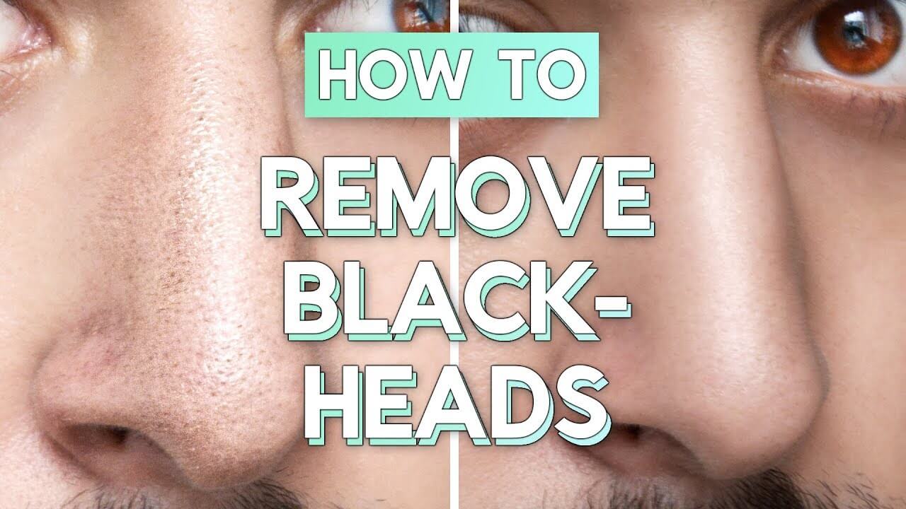 Ways To Remove Blackheads