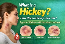What are Hickeys