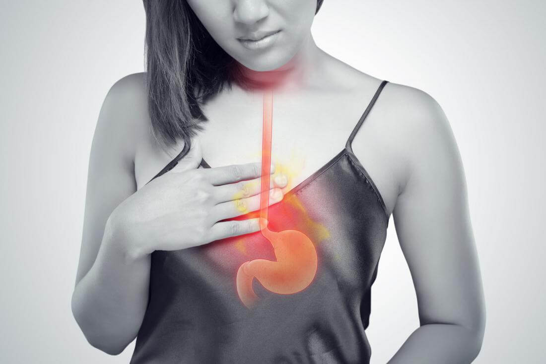 Acid Reflux