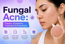 Fungal Acne