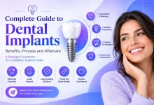 Dental Implants